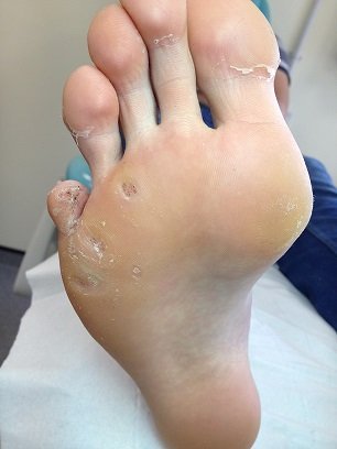 Verruca after treatment