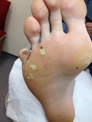 Verruca before treatment
